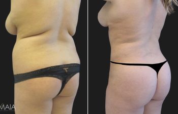 23 year-old before and after liposuction of the abdomen, flanks, upper back, lower back, breast reduction, and fat transfer to the buttocks (BBL)
