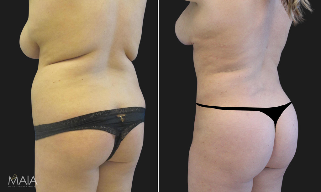23 year-old before and after liposuction of the abdomen, flanks, upper back, lower back, breast reduction, and fat transfer to the buttocks (BBL)