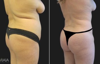 23 year-old before and after liposuction of the abdomen, flanks, upper back, lower back, breast reduction, and fat transfer to the buttocks (BBL)