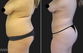 23 year-old before and after liposuction of the abdomen, flanks, upper back, lower back, breast reduction, and fat transfer to the buttocks (BBL)