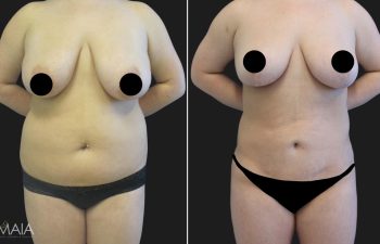 23 year-old before and after liposuction of the abdomen, flanks, upper back, lower back, breast reduction, and fat transfer to the buttocks (BBL)