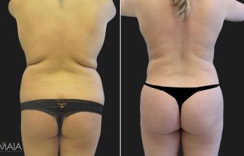 23 year-old before and after liposuction of the abdomen, flanks, upper back, lower back, breast reduction, and fat transfer to the buttocks (BBL)