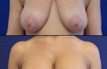 36 year-old before and after breast lift with an augmentation