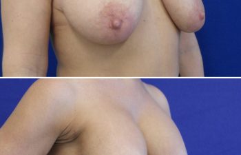 36 year-old before and after breast lift with an augmentation