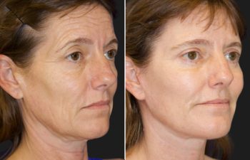 47 year-old before and 5 months after a Facelift, Neck Lift, Brow Lift, Upper and Lower Blepharoplasty, Canthopexy, CO2 laser, and Fat grafting to Face