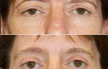 47 year-old before and 5 months after a Facelift, Neck Lift, Brow Lift, Upper and Lower Blepharoplasty, Canthopexy, CO2 laser, and Fat grafting to Face