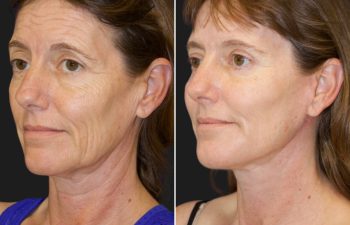 47 year-old before and 5 months after a Facelift, Neck Lift, Brow Lift, Upper and Lower Blepharoplasty, Canthopexy, CO2 laser, and Fat grafting to Face