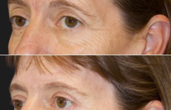 47 year-old before and 5 months after a Facelift, Neck Lift, Brow Lift, Upper and Lower Blepharoplasty, Canthopexy, CO2 laser, and Fat grafting to Face