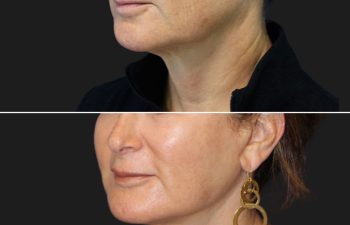 59 year-old female before a 1 month after a mini facelift, mini neck lift, fat grafting to face, TCA peel, and nanofat grafting under the eyes.