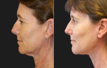 47 year-old before and 5 months after a Facelift, Neck Lift, Brow Lift, Upper and Lower Blepharoplasty, Canthopexy, CO2 laser, and Fat grafting to Face