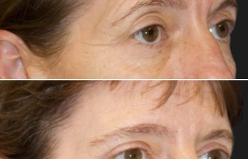 47 year-old before and 5 months after a Facelift, Neck Lift, Brow Lift, Upper and Lower Blepharoplasty, Canthopexy, CO2 laser, and Fat grafting to Face