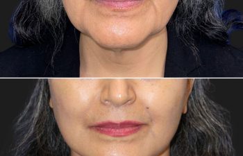 62 year-old before and after mini facelift, mini neck lift, facial fat grafting, nanofat grafting, and Morpheus8