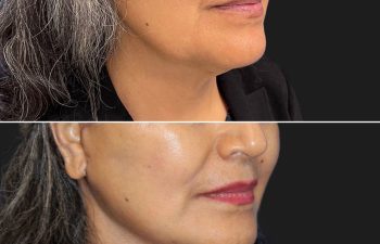 62 year-old before and after mini facelift, mini neck lift, facial fat grafting, nanofat grafting, and Morpheus8