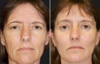 47 year-old before and 5 months after a Facelift, Neck Lift, Brow Lift, Upper and Lower Blepharoplasty, Canthopexy, CO2 laser, and Fat grafting to Face