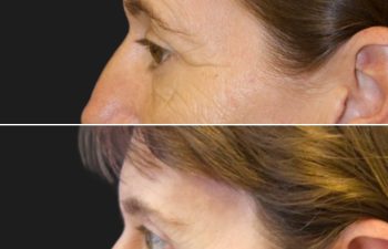 47 year-old before and 5 months after a Facelift, Neck Lift, Brow Lift, Upper and Lower Blepharoplasty, Canthopexy, CO2 laser, and Fat grafting to Face