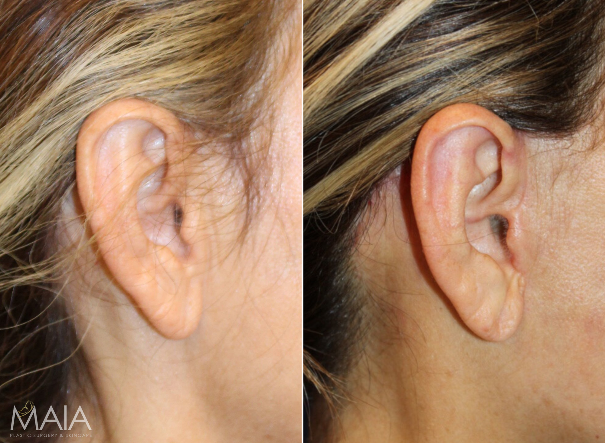 Earlobe Repair  Virginia, Washington D.C. and Maryland