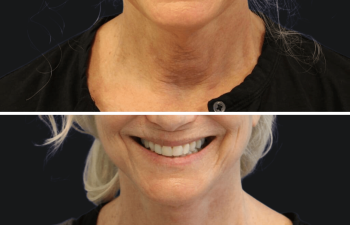 71 year old before and after facelift, neck lift, upper eyelid lift, lower blepharoplasty, canthopexy, fat grafting and TCA peel
