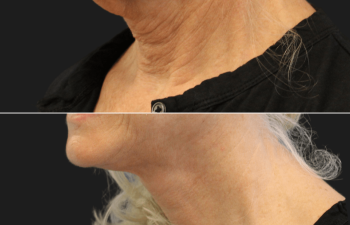 71 year old before and after facelift, neck lift, upper eyelid lift, lower blepharoplasty, canthopexy, fat grafting and TCA peel