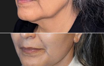 62 year-old before and after mini facelift, mini neck lift, facial fat grafting, nanofat grafting, and Morpheus8