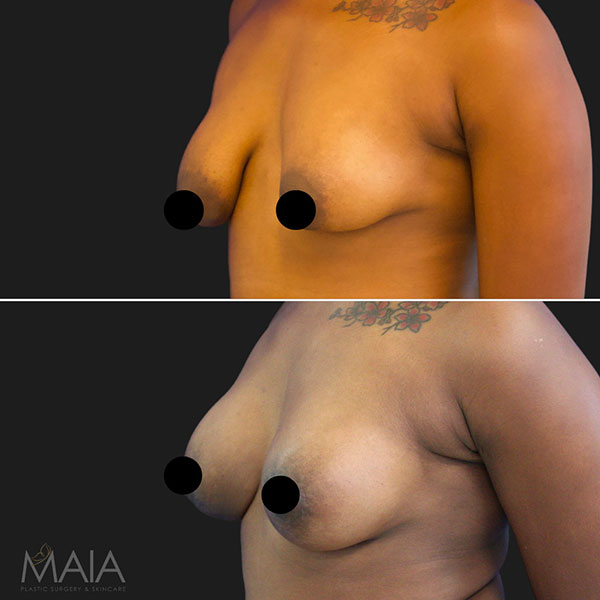 Tuberous Breast Correction