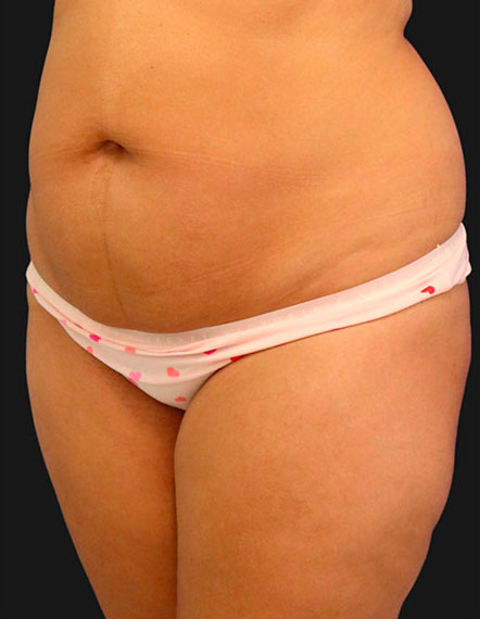 Why BodyTite With Tickle Lipo Are Your Best Body Contouring Solutions