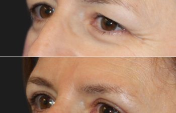 53 year-old patient before and 2 months after an upper blepharoplasty and brow lift.