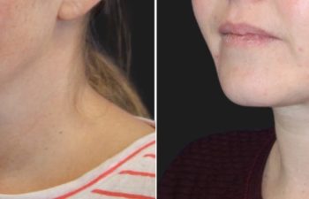34 year-old before and 3 months after Neck Liposuction and TCA Peel
