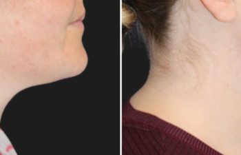 34 year-old before and 3 months after Neck Liposuction and TCA Peel