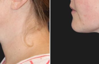 34 year-old before and 3 months after Neck Liposuction and TCA Peel