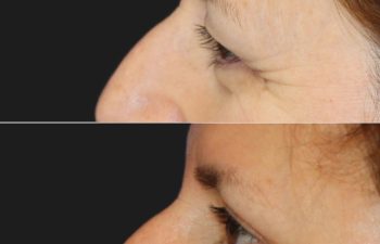 53 year-old patient before and 2 months after an upper blepharoplasty and brow lift.