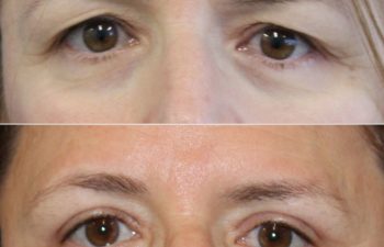 53 year-old patient before and 2 months after an upper blepharoplasty and brow lift.