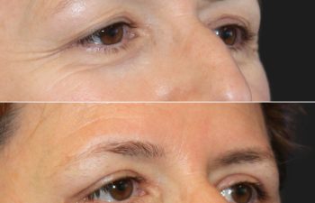 53 year-old patient before and 2 months after an upper blepharoplasty and brow lift.