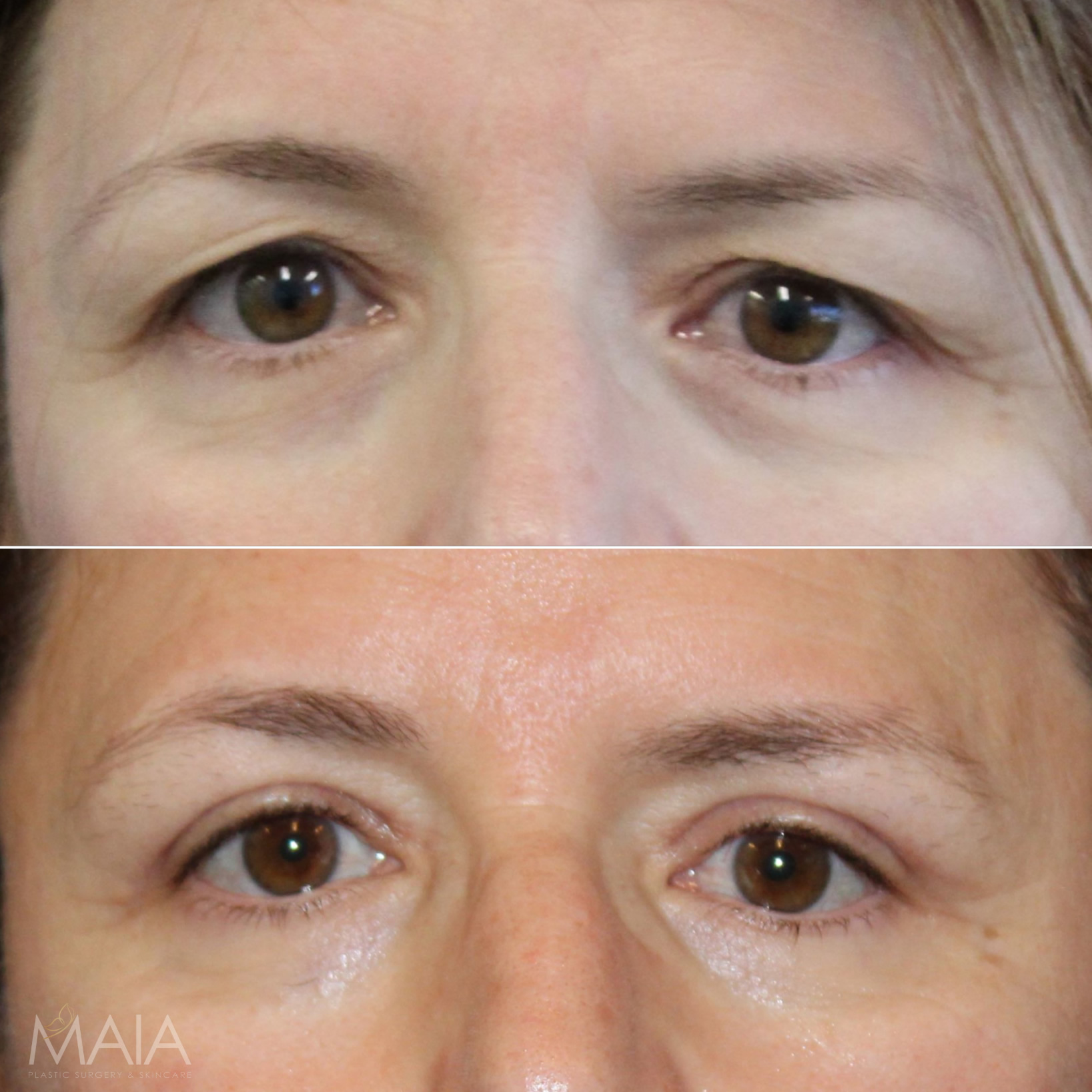 53 year-old patient before and 2 months after an upper blepharoplasty and brow lift.