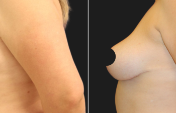 42 year-old before and 7 months after Mommy Makeover: Tummy Tuck, Flank Liposuction, Breast Lift, Hernia Repair