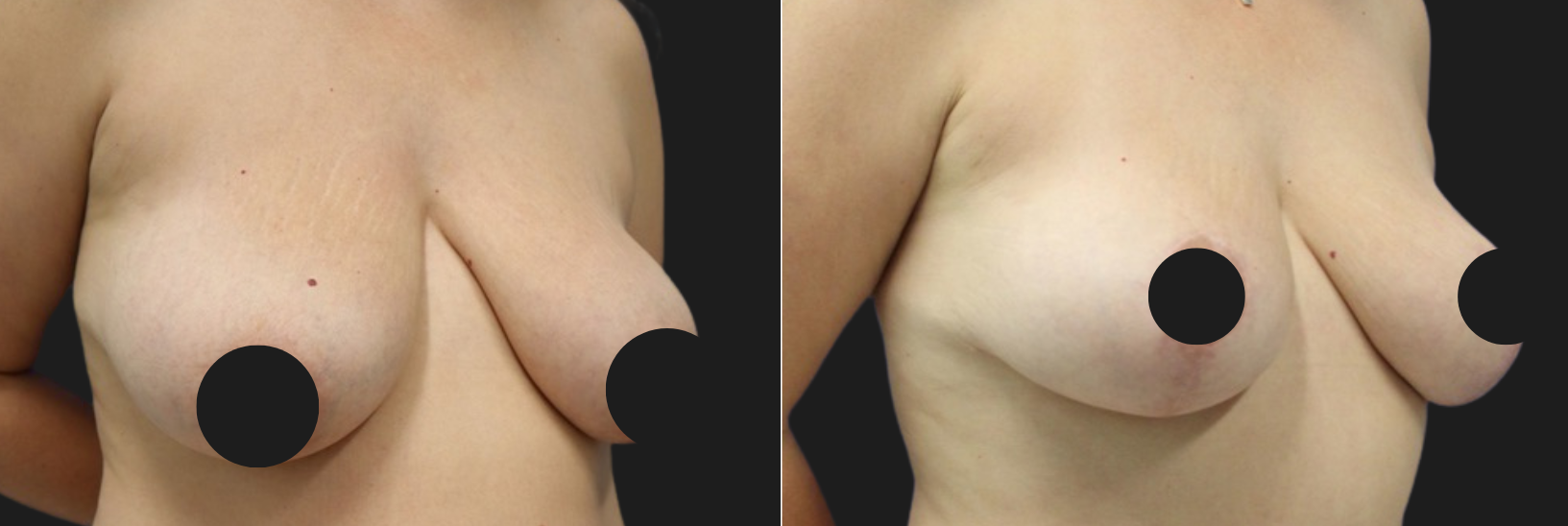 42 year-old before and 7 months after Mommy Makeover: Tummy Tuck, Flank Liposuction, Breast Lift, Hernia Repair