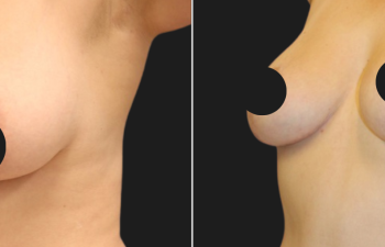 42 year-old before and 7 months after Mommy Makeover: Tummy Tuck, Flank Liposuction, Breast Lift, Hernia Repair