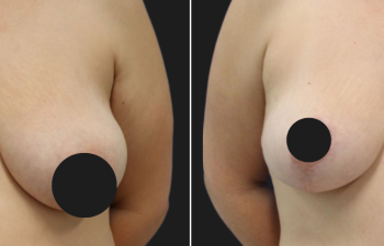42 year-old before and 7 months after Mommy Makeover: Tummy Tuck, Flank Liposuction, Breast Lift, Hernia Repair