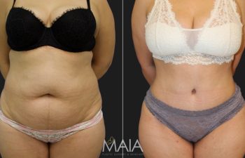 Comparación lado a lado de una persona antes y después de un procedimiento cosmético de contorno corporal, que muestra cambios visibles en las áreas del abdomen y la cintura.