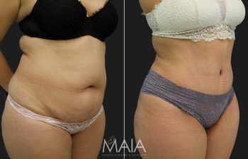 before and after tummy tuck procedure