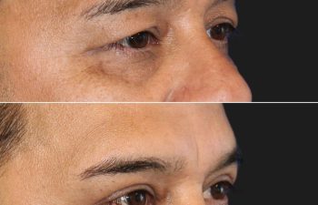 45 year-old before and 3 months after an upper blepharoplasty and internal brow lift