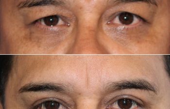 45 year-old before and 3 months after an upper blepharoplasty and internal brow lift