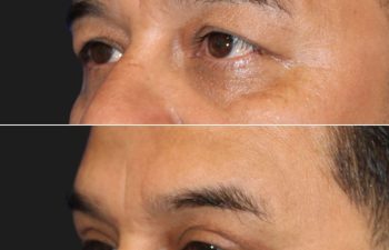 45 year-old before and 3 months after an upper blepharoplasty and internal brow lift