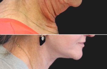 70 year-old patient before and after facelift, neck lift, lower and upper blepharoplasty, brow lift, canthopexy, fat grafting, lip lift, lip filler, and CO2 laser