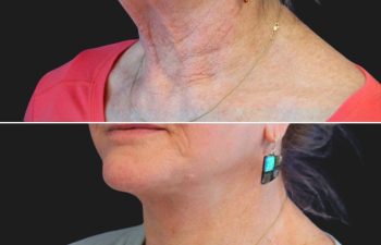 70 year-old patient before and after facelift, neck lift, lower and upper blepharoplasty, brow lift, canthopexy, fat grafting, lip lift, lip filler, and CO2 laser