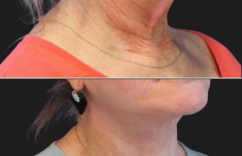 70 year-old patient before and after facelift, neck lift, lower and upper blepharoplasty, brow lift, canthopexy, fat grafting, lip lift, lip filler, and CO2 laser