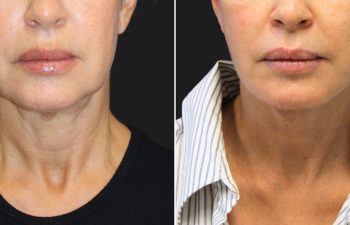 55 year-old patient before and 5 weeks after custom facial rejuvenation surgery. Facelift, neck lift, fat grafting to the face, nanofat grafting under the eyes.