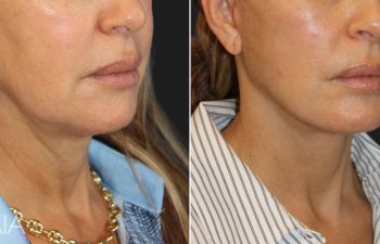 55 year-old patient before and 5 weeks after custom facial rejuvenation surgery. Facelift, neck lift, fat grafting to the face, nanofat grafting under the eyes.