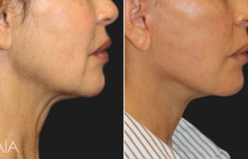 55 year-old patient before and 5 weeks after custom facial rejuvenation surgery. Facelift, neck lift, fat grafting to the face, nanofat grafting under the eyes.