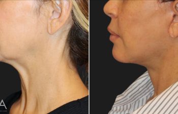 55 year-old patient before and 5 weeks after custom facial rejuvenation surgery. Facelift, neck lift, fat grafting to the face, nanofat grafting under the eyes.