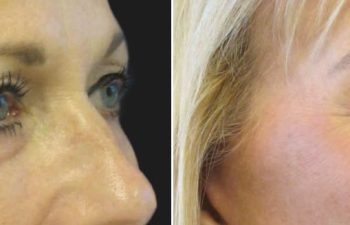 67 year-old before and after a facelift, neck lift, upper and lower blepharoplasty, brow lift, facial fat grafting, TCA Peel and skincare treatment